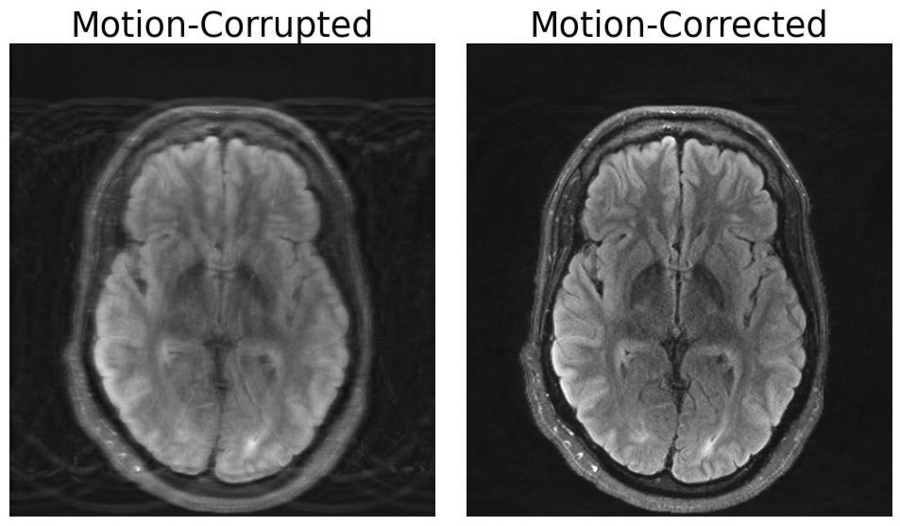 MRI motion artifact correction